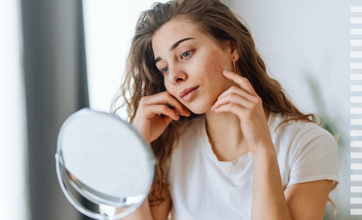 Die besten Tipps gegen Rötungen im Gesicht